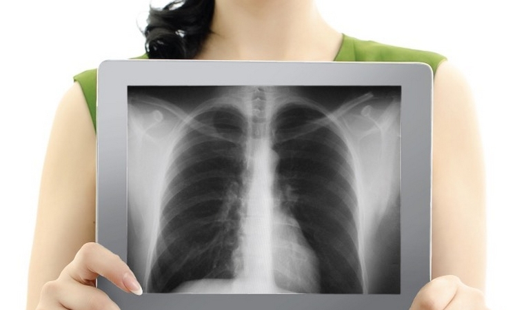 Флюорография сегодня — спокойствие завтра!